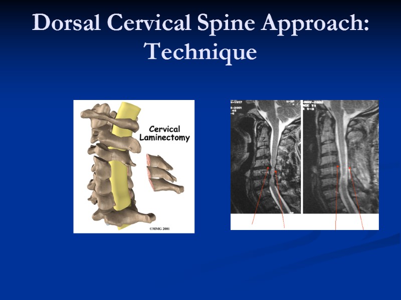 Dorsal Cervical Spine Approach: Technique